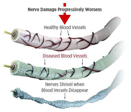 Nerve Damage Progression